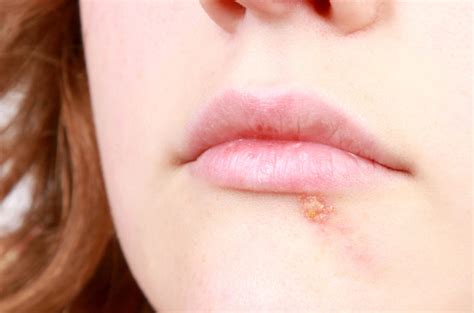 Remedy For Burnt Mouth Syndrome First First Aid Reference