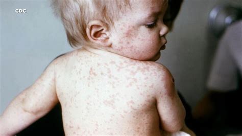 Tips To Identify And Diagnose A Viral Rash In Infants