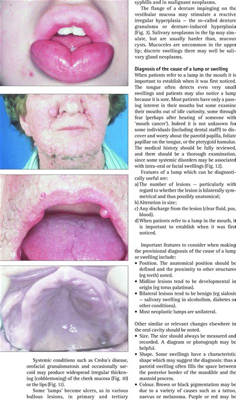 Orofacial Granulomatosis With Chronic Lip Swelling Download