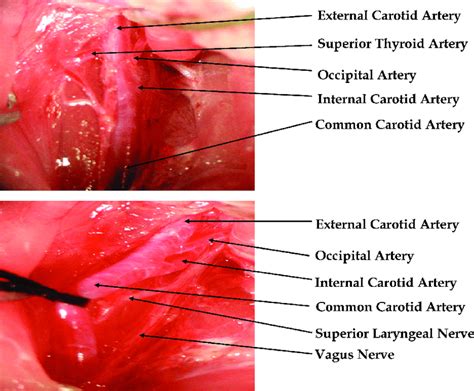 Carotid wall invasion most often arises either from direct extension of a primary head and neck squamous cell carcinoma of the pharynx or from bulky in the previously untreated neck, carotid arteries that are abutted less than 180o of their circumference by imaging are highly unlikely to. Dissection of the carotid artery. After displacing the ...