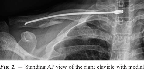 Figure 2 From Intramedullary Nailing Of Displaced Midshaft Clavicle