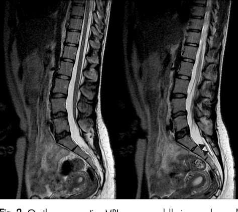 Figure 2 From A Tethered Cord With Hemivertebra A Case Report And