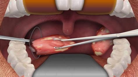 Tonsillectomy The Tonsils And Adenoid When Tonsillectomy Is Necessary