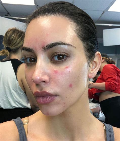 Kim Kardashian Posa Sin Maquillar Para Visibilizar Su Psoriasis Divinity