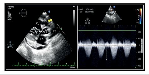 Figure 1 From Isolated Infundibular Pulmonary Stenosis With Infectious