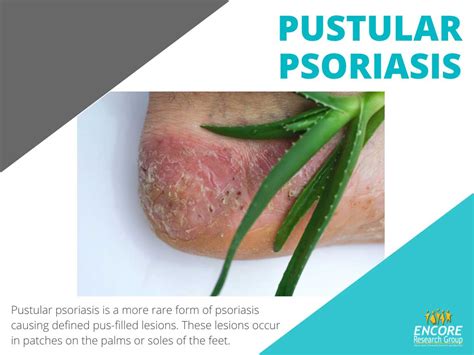 Psoriasis Its More Than Just The Skin Encore Research Group