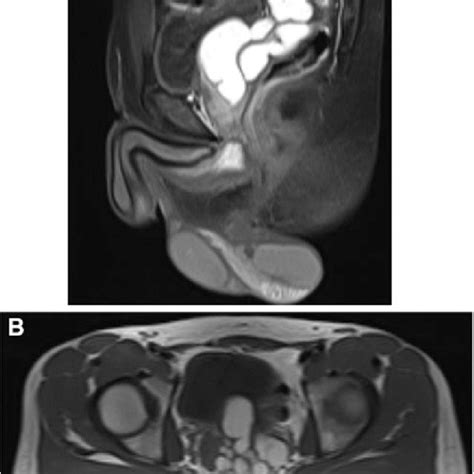 Sagittal A And Axial B Mri Images Show A Large 5 · 65 · 8 Cm
