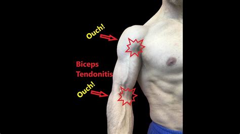 Biceps Tendonitis Stretches And Fascial Release Youtube Bicep Tendonitis Shoulder Rehab