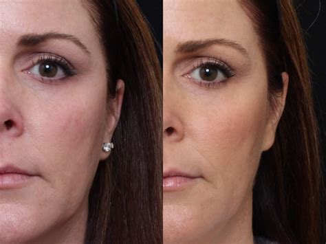 Injectable Fillers Before And After Brian S Biesman Md