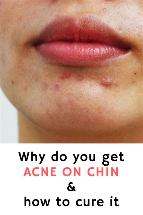 What Causes Cystic Acne On Cheeks Beckybeatle