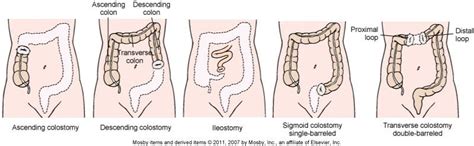 Different Types Of Ostomies I Had An Ileostomy Nursing Information