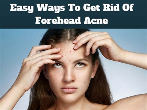 Get Rid Of Forehead Acne With These Easy And Effective Home Remedies