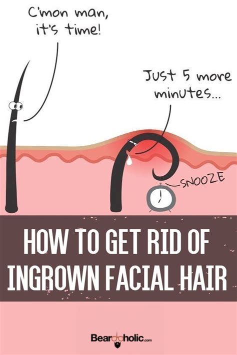 How To Get Rid Of Ingrown Facial Hair Causes Prevention And Removal