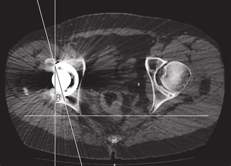 Ct Scan Of Pelvis At The Hip Level Measuring Of Retroversion Angle R