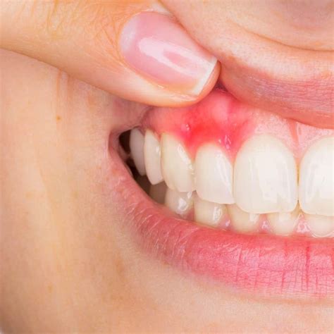 How You Can Treat The Periodontal Abscess Home