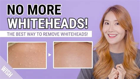 How To Remove Whiteheads Small Bumps Whitehead Removal To Prevention