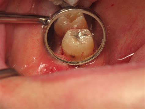 Sweet Tooth Distal Decay On 2nd Molars