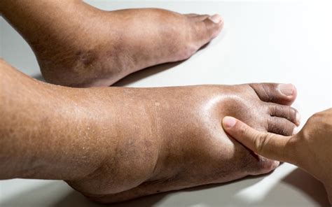 Causes Of Foot And Ankle Swelling Huntington Orthopedics