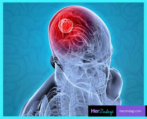 Brain Tumor Can Be Cancerous Know How Herzindagi