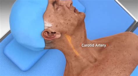 How To Check For A Patients Pulse Using The Carotid Artery World Of
