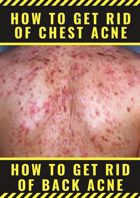 How To Get Rid Of Chest Acne How To Get Rid Of Back Acne