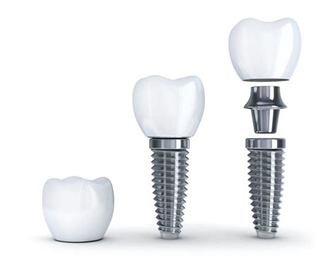 What Is A Single Tooth Dental Implant Morristown Nj Dentist