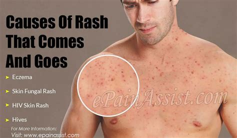 Causes Of Rash That Comes And Goes And Its Treatment