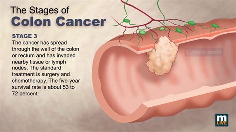 What Is Colon Cancer Cause Symptoms Stage And Treatment Wikye