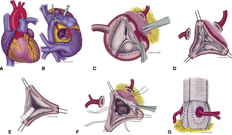 Outcomes And Risk Factors Of Late Failure Of Valve Sparing Aortic Root