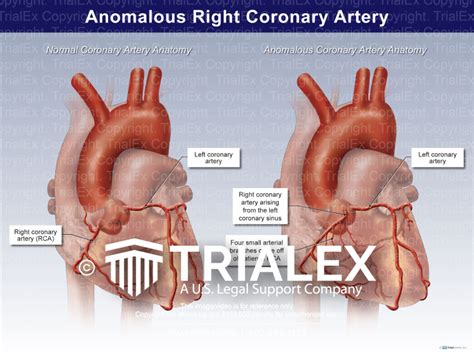 Anomalous Right Coronary Artery Trialexhibits Inc