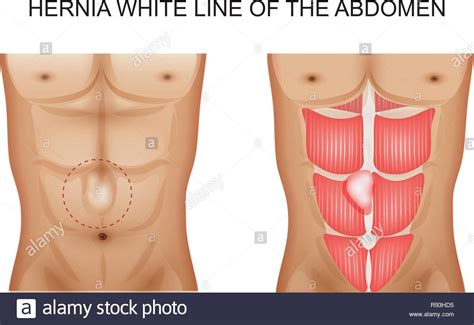 Stomach Hernia Illustration Stock Vector Images Alamy