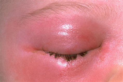 Cellulitis Cheek