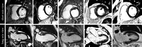 Illustration Of Late Gadolinium Enhancement Patterns Found In