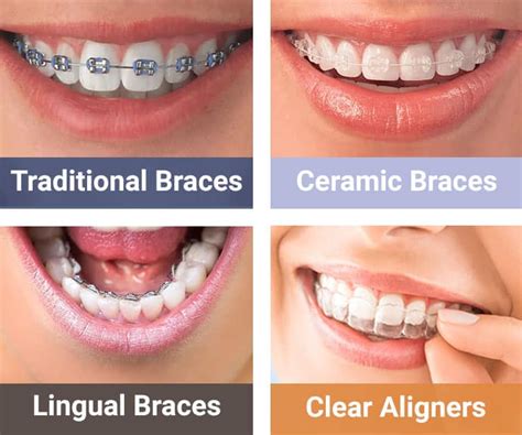 Dental Braces Nyc Ceramic Clear Gibbs Orthodontics