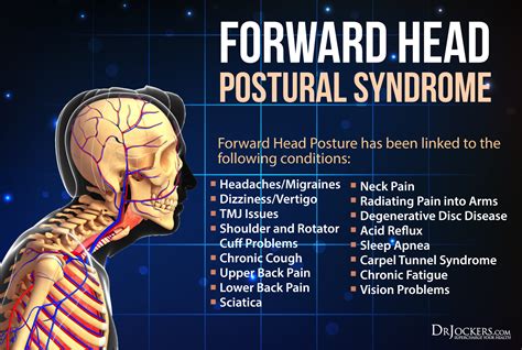 Bad Posture Results In Bad Overall Health