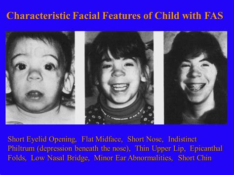 Many affected infants also have unusually flat midfacial regions (midfacial hypoplasia), including a short nose, flattened nasal bridge, and upturned nostrils (anteverted nares); Flat Nasal Bridge And Epicanthal Folds : Out Of Context ...