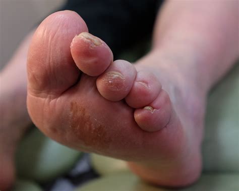 how can diabetes affect my feet feel your feet community