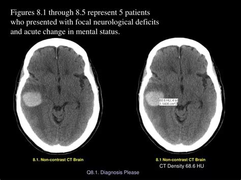 Ppt 81 Non Contrast Ct Brain Powerpoint Presentation Free Download