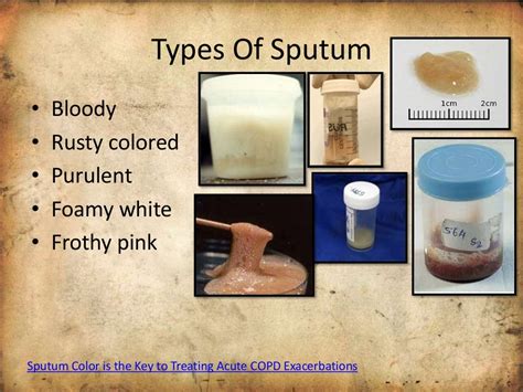 Use Of Sputum Sample For Diagnosis Of Disease Interpretation Treatm