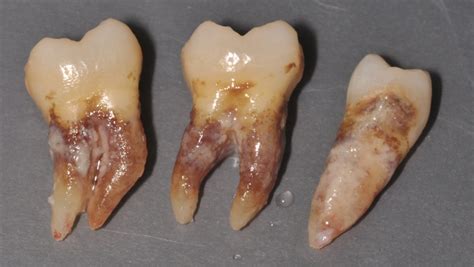 The Dental Plaque Biofilm Matrix Jakubovics 2021 Periodontology