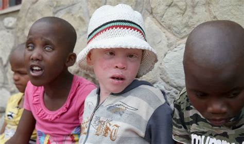 Shocking Albinos Are Being Abducted Killed Mutilated In Malawi
