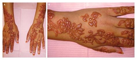 Allergic Contact Dermatitis From A Henna Tattoo Nejm