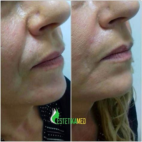 Nasolabial Folds Before And After Juvederm Volift 1ml Nasolabial