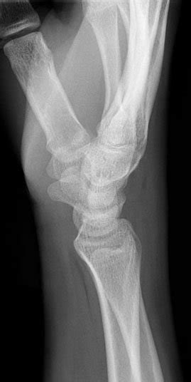 X Rays Upper Limb
