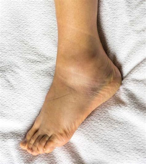 If You Have Recurrent Swollen Feet And This Is Not Due To Any Serious