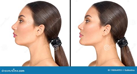 Before And After Plastic Surgery Of A Chin Cosmetic Correction Small