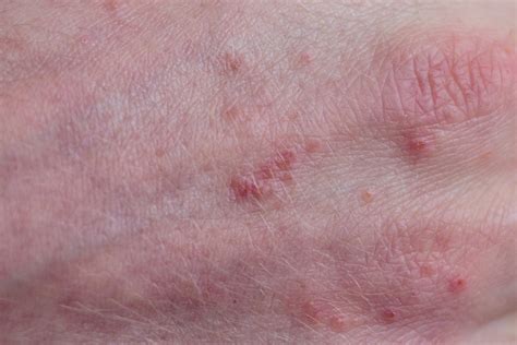 How Can You Find The Cause Of Skin Inflammation Text2md