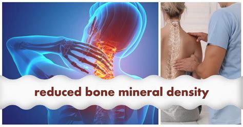 Anxiety Disorders And Reduced Bone Mineral Density In Men Nutri Life