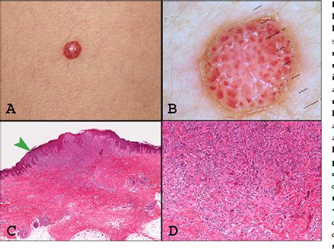 Figure 3 From Hypopigmented Atypical Spitzoid Neoplasms Atypical Spitz