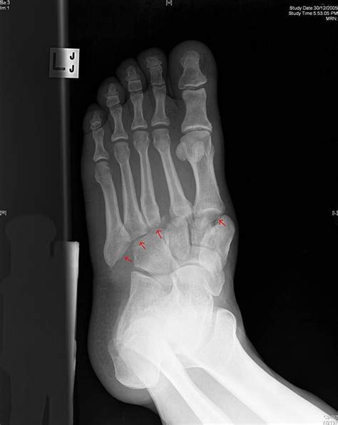 Lisfranc Injury Sustained From Sudden Twisting Motion On Uneven Ground